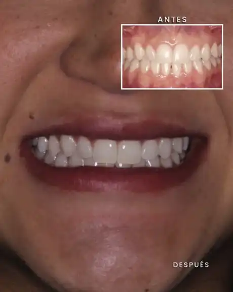Antes y después: blanqueamiento dental