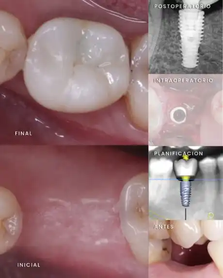 Antes y después: implante y corona
